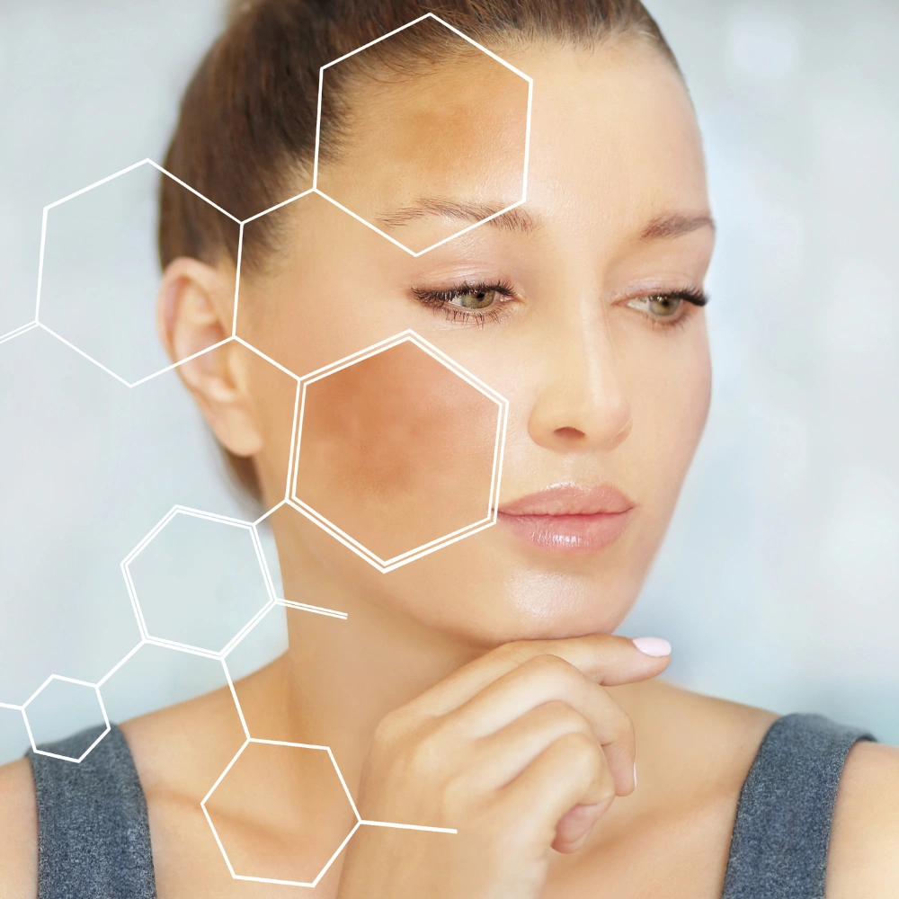 Hyperpigmentation
