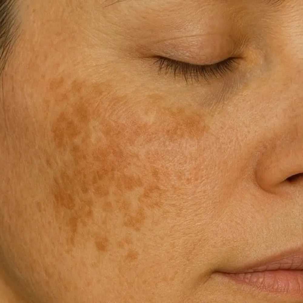 Melasma