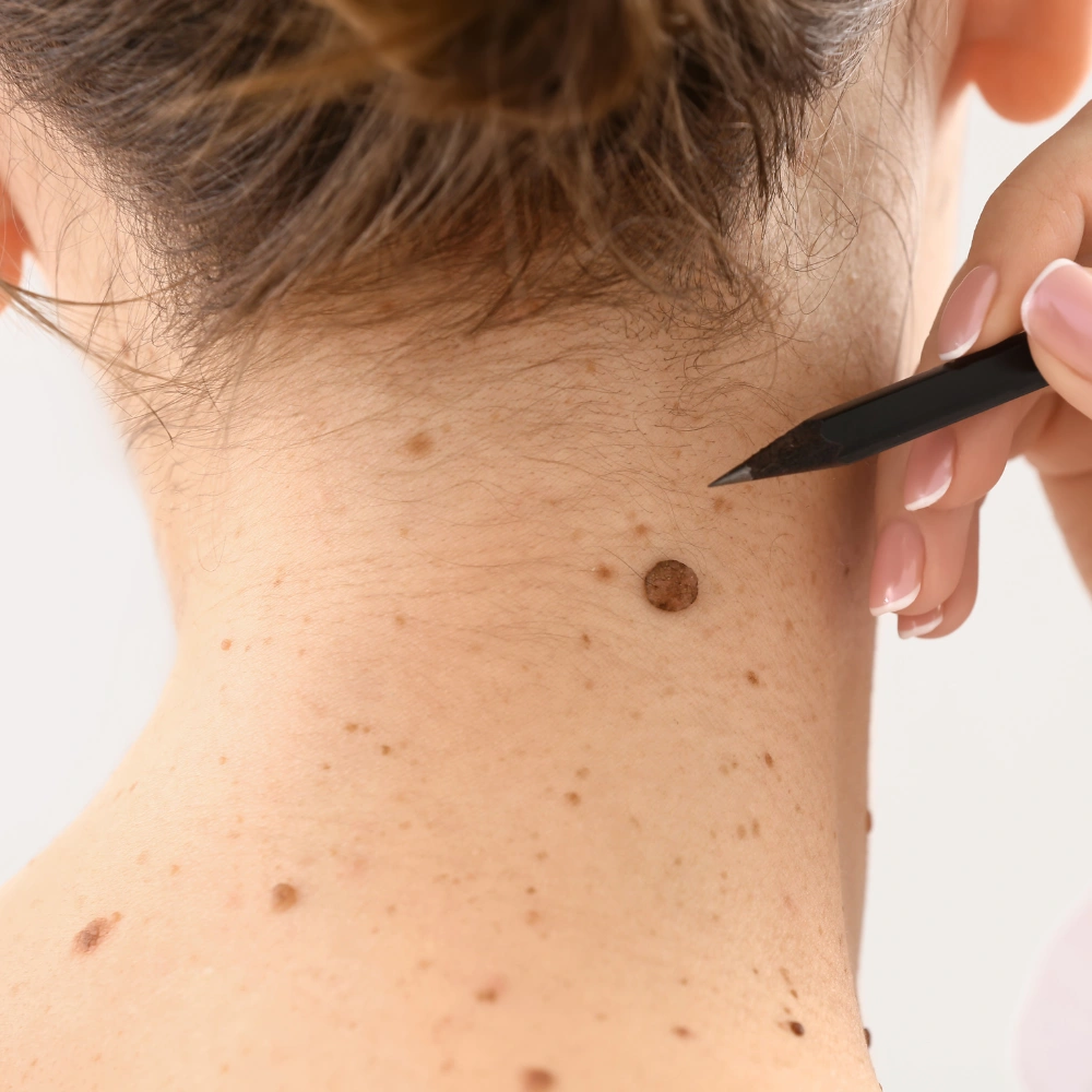 Mole Removal