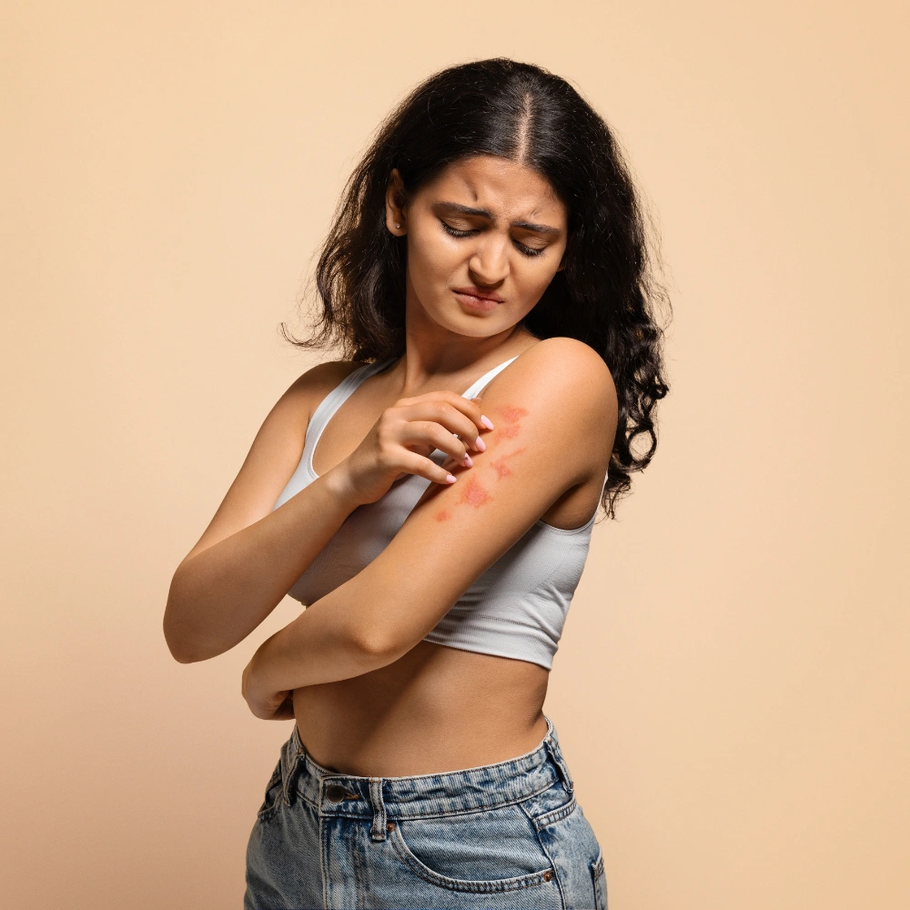 Psoriasis