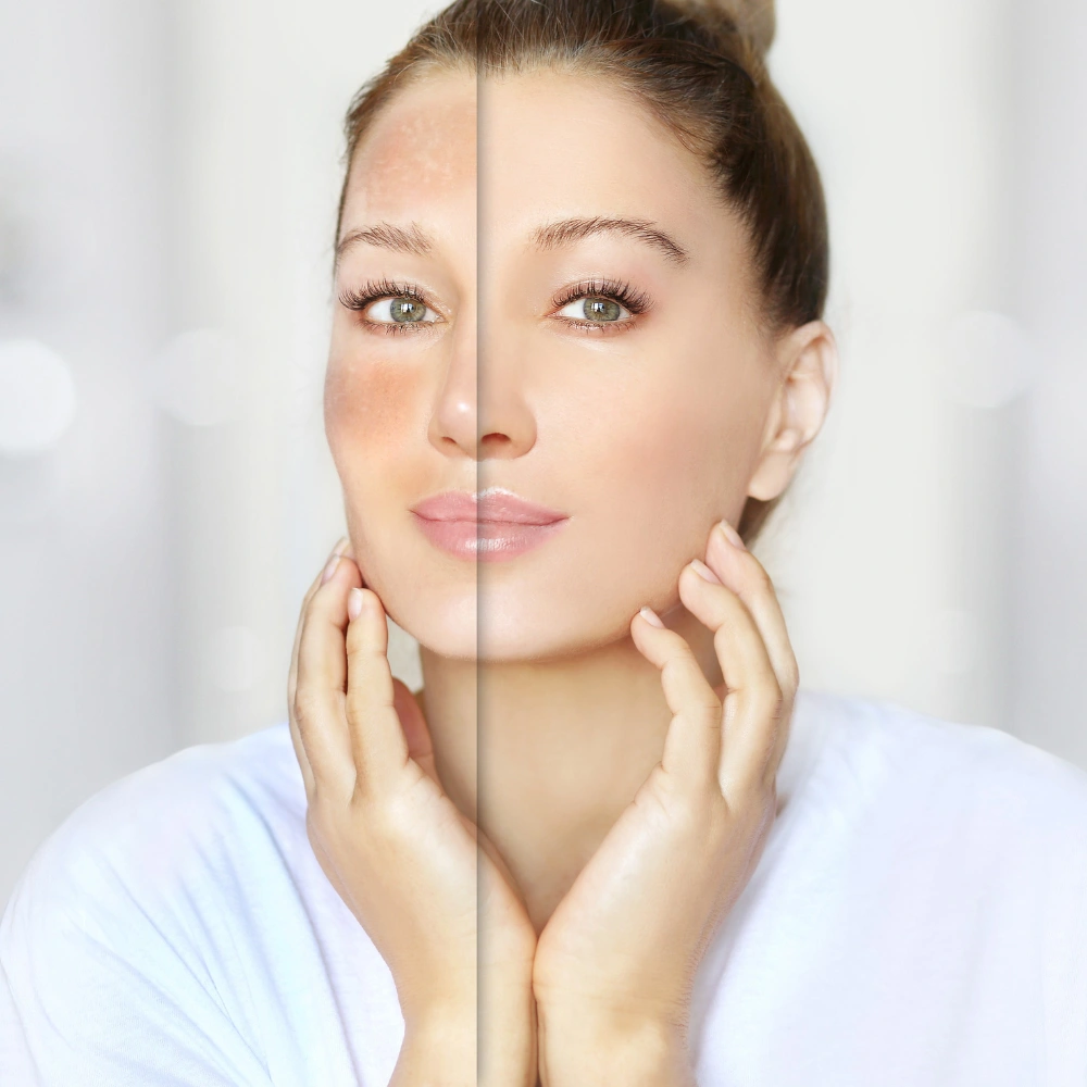 Skin Boosters and Exosomes