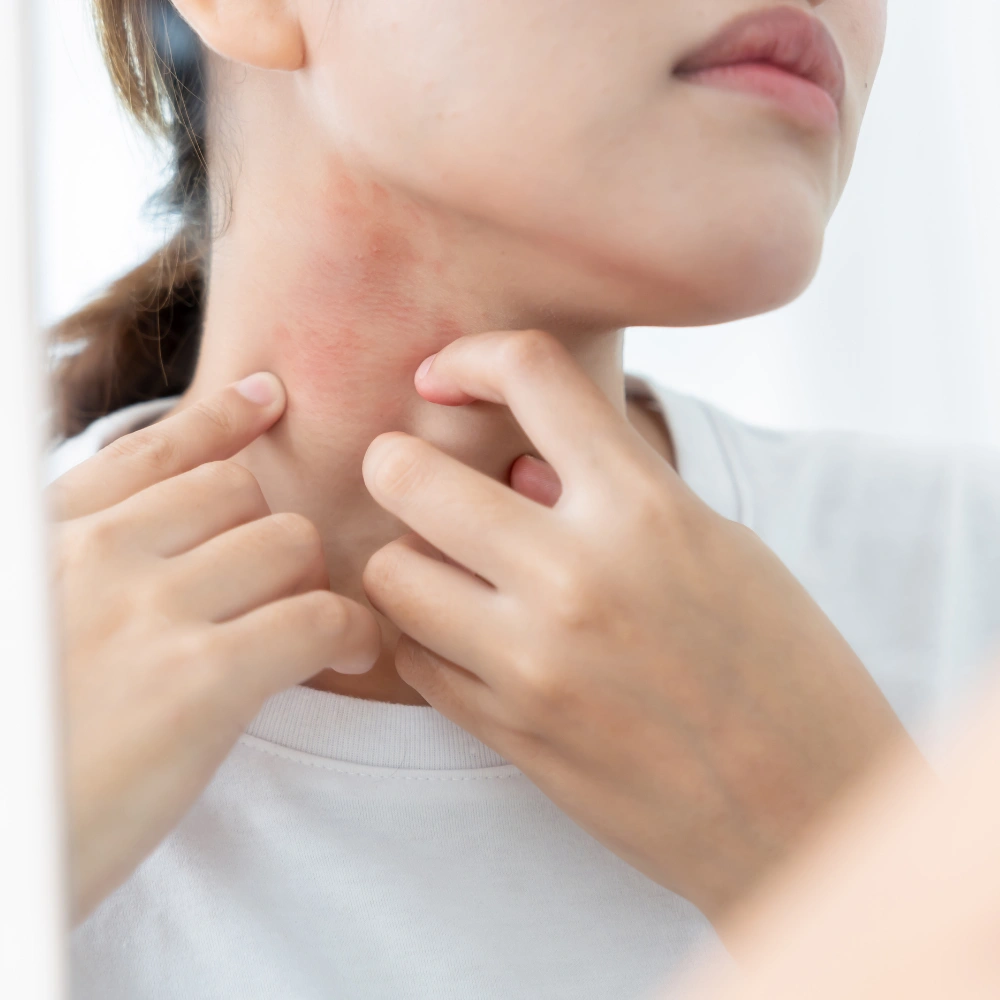 Skin Infections